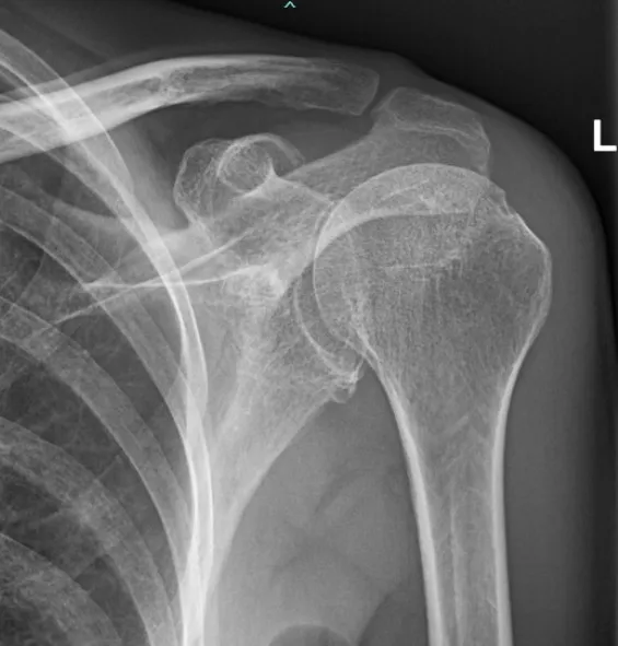 Digitale radiografie van de schouder